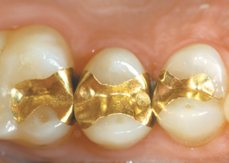 Gold Restorations Ideal Dentistry